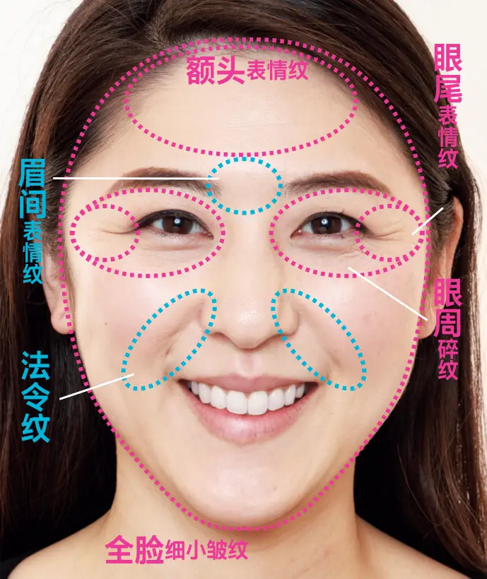 醫療美容 | 表情紋、眼周紋、法令紋，針對性改善！
