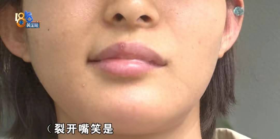 女主播杭州美萊醫療美容醫院近6萬元整形致嘴角抽搐無法微笑