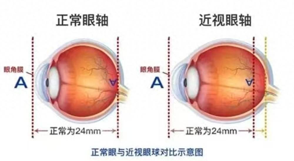 為什麼有些孩子佩戴防控眼鏡後會出現眼軸回退的現象？