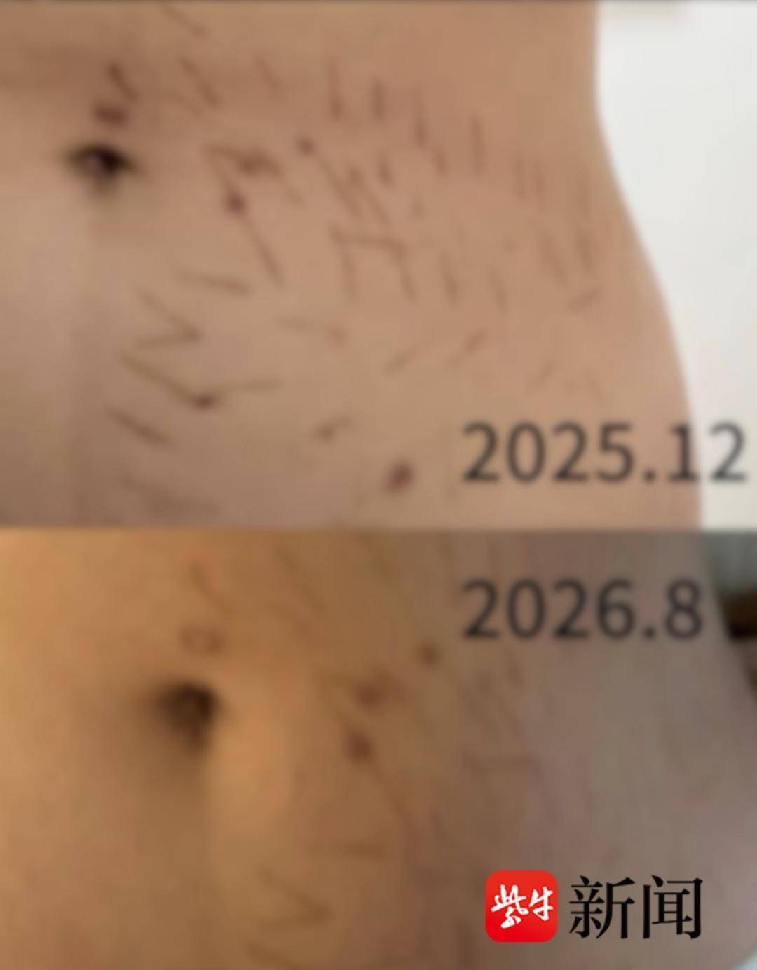 18歲女生在美容院“瘦腰”致皮膚損傷，數十條炎症印記與瘢痕九個月未消，衛健委回應：已介入處理